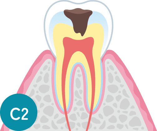 C2:象牙質の虫歯の断面図