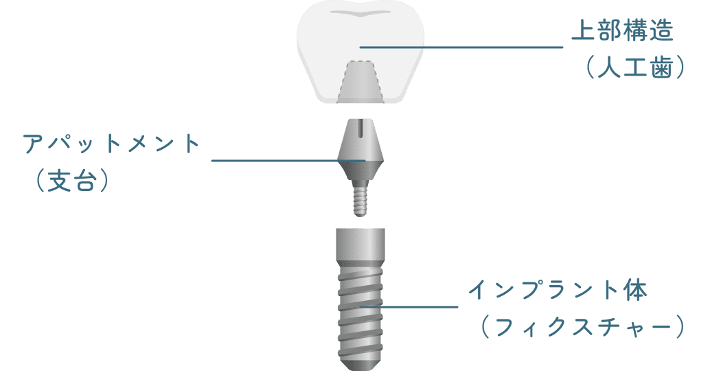 インプラントの3つのパーツ(人工歯、アバットメント、フィクスチャー)
